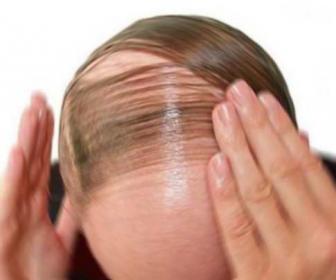 capelli artificiali permanenti