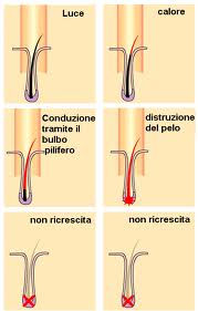 epilazione laser foto